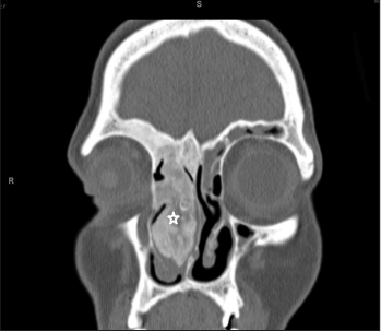 Endoscopic Paring Down of Fibrous Dysplasia of the Middle Turbinate