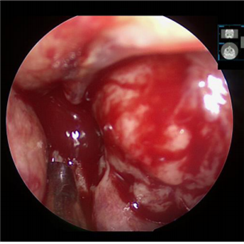 Sinonasal Involvement in Disseminated Mycobacterium Haemophilum Infection