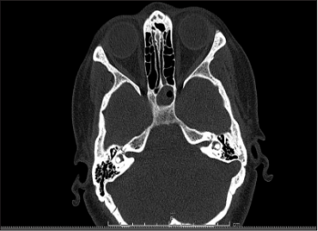 Isolated Sphenoid Sinus Lesions