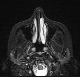 Comparison of Radiofrequency and Microdebrider-Assisted Turbinoplasty for Treatment of Isolated Inferior Turbinate Hypertrophy