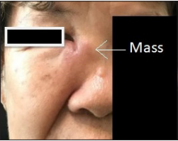 Primary Extranodal Non-Hodgkin’s Lymphoma of Maxillary Sinus: Rare Incident