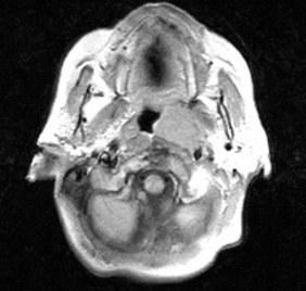 Small Lymphocytic Lymphoma Arising from the Nasopharynx