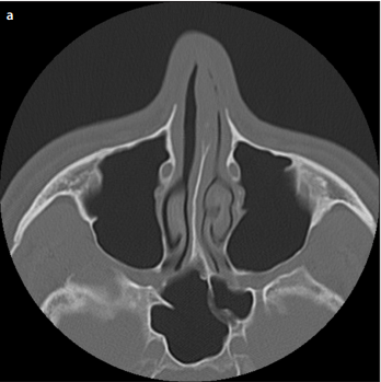 Evaluation of Maxillary Sinus and Nasolacrimal Canal Relationship via Paranasal Sinus Tomography Imaging
