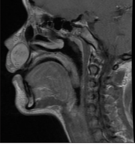 A Rare Nasoalveolar Region Schwannoma