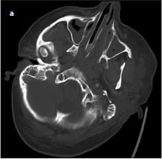 A Rare Reproduction in Paranasal Sinuses; Lophomonas Blattarum