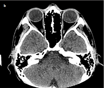 Orbital Abscess in the Case of Amblyopia