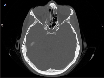 Paranasal Sinus Osteomas: Surgical Outcomes at a Single Institution
