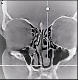 Volumetric Computed Tomography Analysis of Middle Turbinate Aeration (Concha Bullosa) in Nasal Septal Deviation