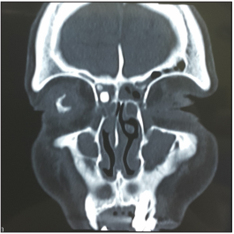 The Missing Piece Found after 25 Years: Foreign Body in Frontal Recess