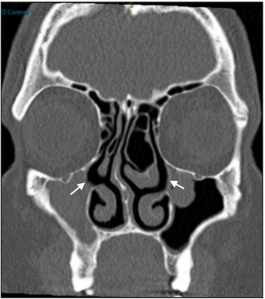 Bilateral Chronic Maxillary Atelectasis with a Unilateral Accessory Ostium