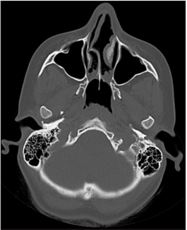 A Rare Case Report: Bilateral Choanal Atresia in an Adult Patient